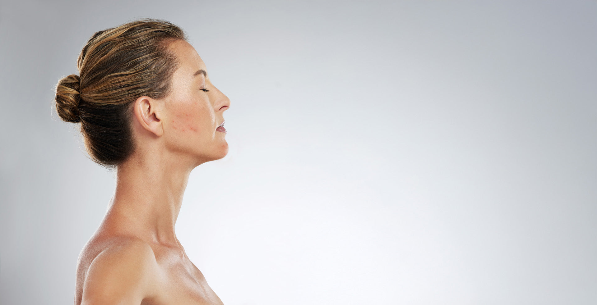 Skin Barrier